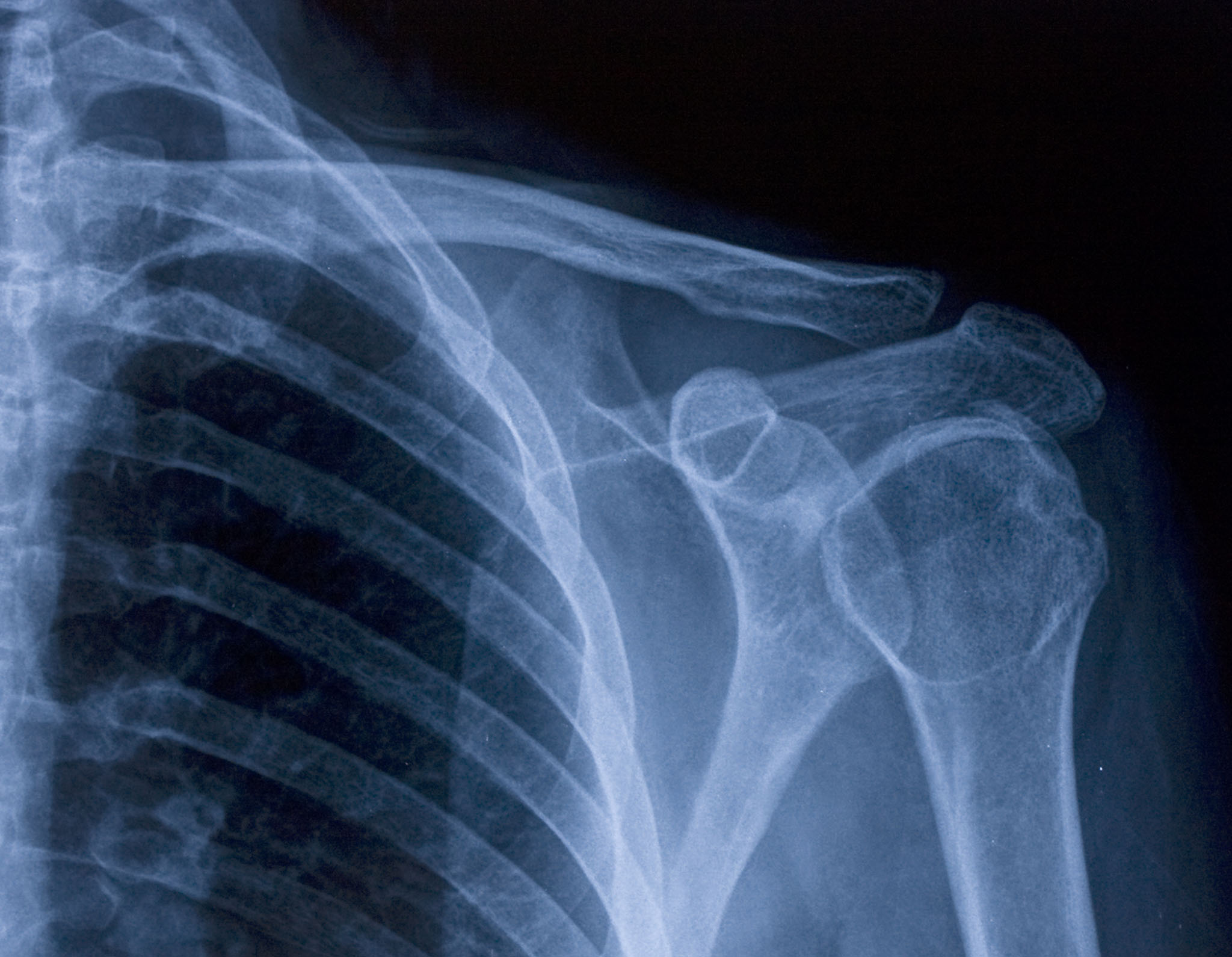 X-ray image of shoulder Diagnostic Imaging