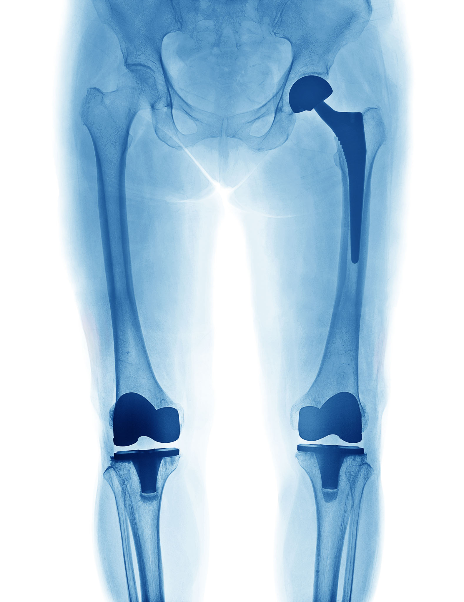 X Ray image of hip replacement and knee replacement isolated on white background X-ray image of a pelvis and both legs showing hip and knee replacements, with metal implants visible in the right hip and both knees. Bones and joints are clearly outlined.