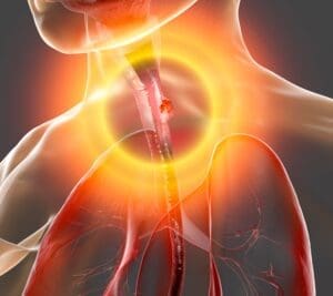 EsophagealCancerAD Images SQUARE