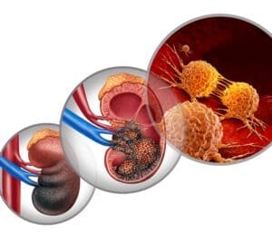 kidneyCancerAD Images SQUARE