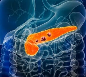 pancreaticCancerAD Images SQUARE