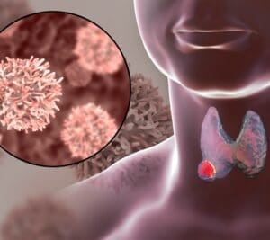 thyroidCancerAD Images SQUARE
